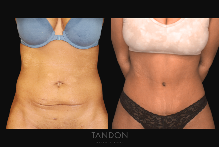 Before and After photo of an Abdominoplasty procedure by Dr. Vickram Tandon in Boston, MA