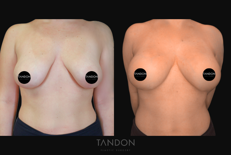 Before and After photo of a Breast Revision procedure by Dr. Vickram Tandon in Boston, MA